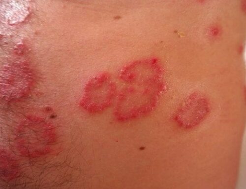 CAN I TAKE SULFONYLUREAS WITH A SULFA ALLERGY