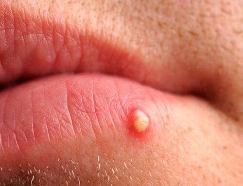 Herpes Facts